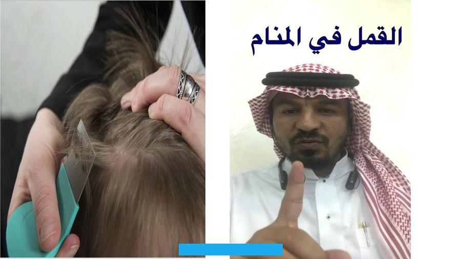 تفسير القمل في الحلم للامام الصادقالقمل أحد الحشرات التي تعيش بين شعر مضيفيها. يتغذى القمل عن طريق امتصاص دم مضيفه.