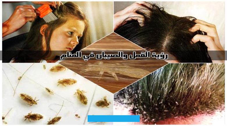 يعتبر حلم تمشيط الشعر وتساقط القمل من الأحلام التي قد تحمل الكثير من الدلالات والمعاني. هذا الحلم يعكس حالة نفسية للشخص لا يجب تجاهلها. ويتميز بالرموز المرتبطة بالنظافة الشخصية والتخلص من الأشياء السيئة في الحياة.يُعتبر شعر الإنسان رمزًا لجماله ومرتبطًا. بينما القمل يُعتبر رمزًا للأفكار السلبية أو الطاقات السلبية التي قد تؤثر على حياة الفرد.